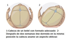 Plagiocefalia3.Osteopata.Madrid.RdP.Osteopata