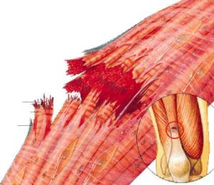 rotura fibrilar-madrid osteopata-RdP.Osteopata2